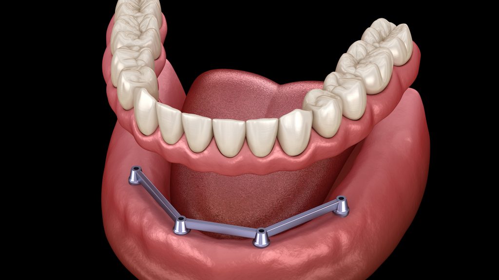 implant retained silkstone